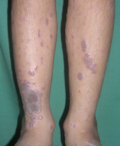 medicines for lichen planus