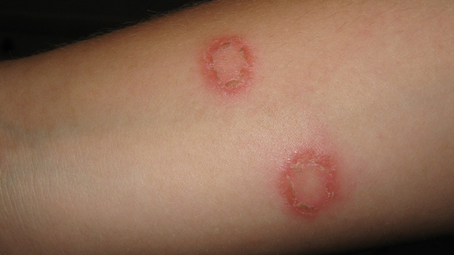 Dermatophytosis / Ringworm / Tinea Ayurvedic Natural Treatment