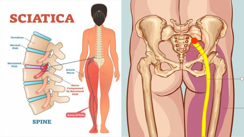 Sciatic neuritis or Sciatica Ayurvedic Herbal Treatment