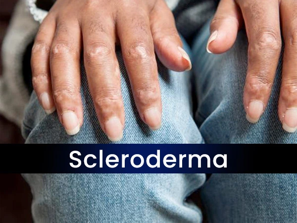 Scleroderma Ayurvedic Herbal Treatment