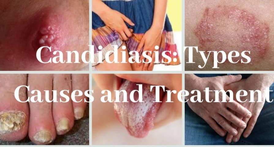 Candida yeast deals infection treatment