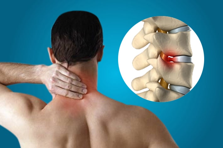 Ayurveda herbal treatment of cervical spondylosis in Adelaide