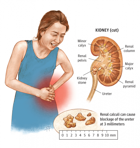 How do you get shop rid of kidney stones