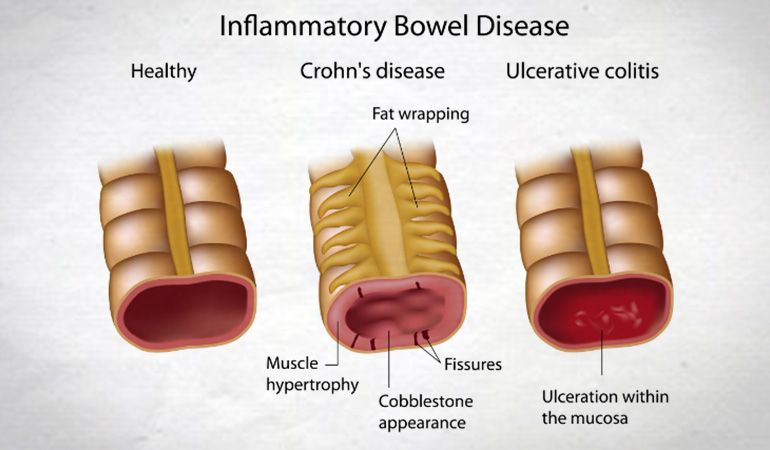 Crohns disease