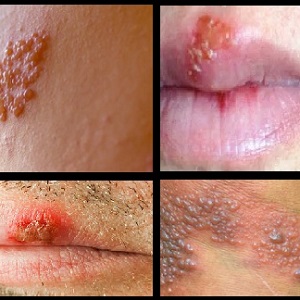 cold sores hsv 2