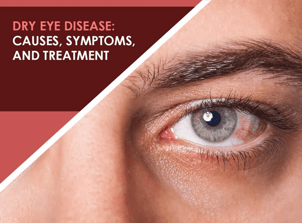 Dry Eye Syndrome Ayurvedic Herbal Treatment