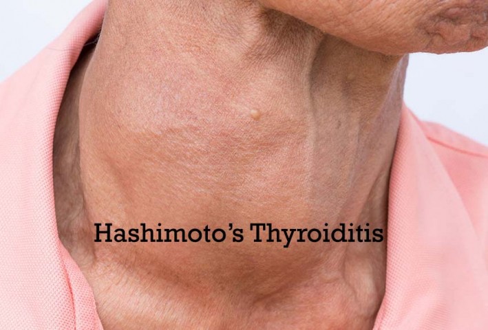 Hashimoto's Thyroiditis Disease Ayurvedic Herbal Treatment