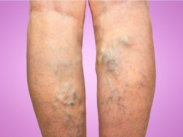 How to Treat Varicose Veins in Your 20s 