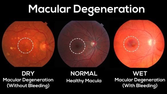 macular degeneration surgery