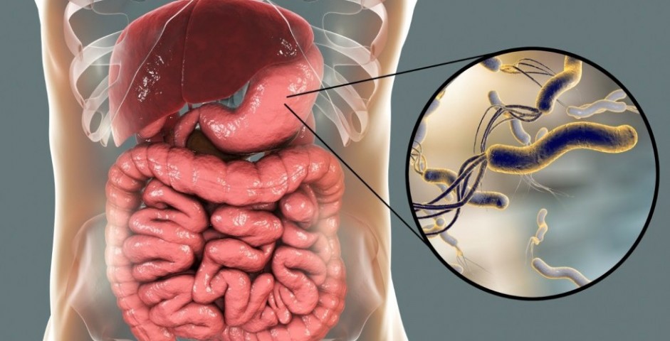 A Helicobacter pylori a vashiányhoz kapcsolódik