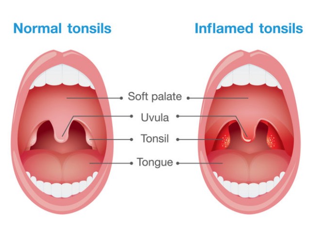 Tonsillitis Ayurvedic Herbal Treatment