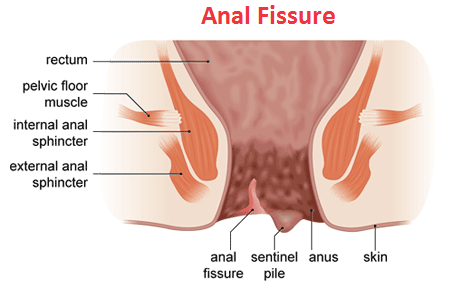 internal anal fissure