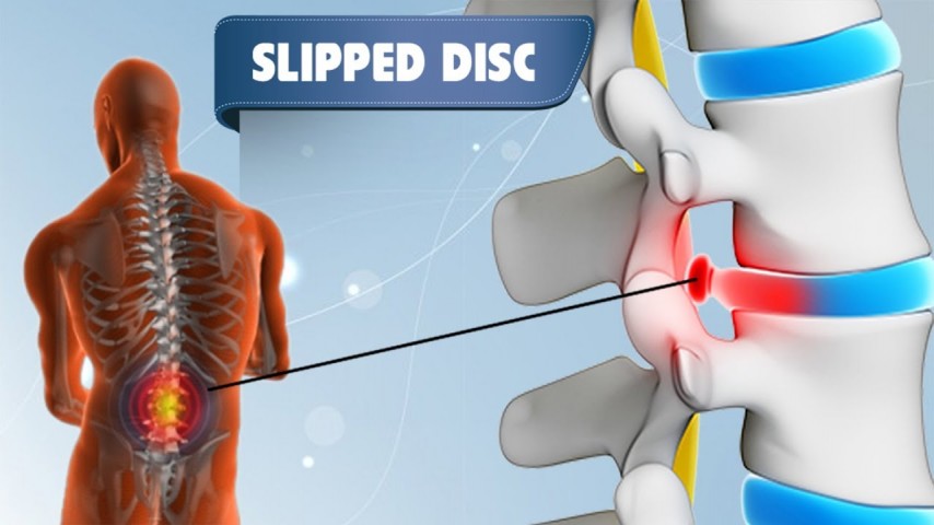 Slip Disc Disc Herniation Disc Bulge Disc Protrusion Ayurvedic