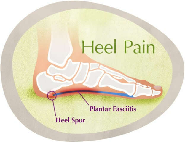 heel thorns treatment