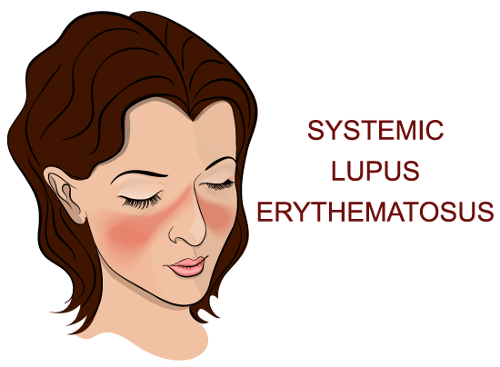 SLE Systemic Lupus Erythematosus Ayurvedic Natural Treatment