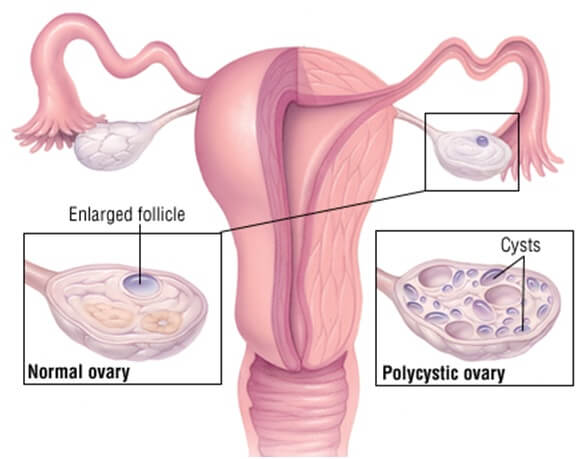 PCOS Polycystic ovarian syndrome Ayurvedic Herbal Treatment