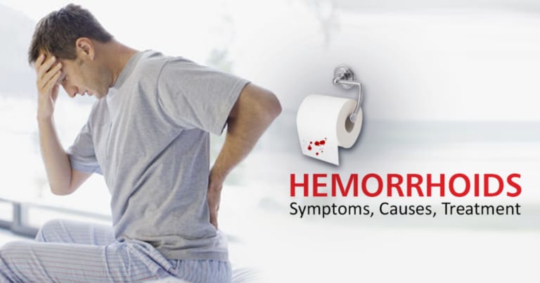 Hemorrhoids  or Piles Ayurvedic Herbal Treatment