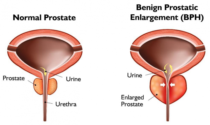 Prostate Enlagement (BPH) Ayurvedic Herbal Treatment