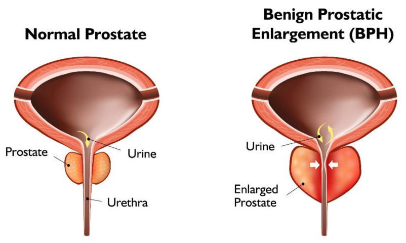 Benign Prostatic Hyperplasia (BPH): Symptoms, Diagnosis & Treatment -  Urology Care Foundation